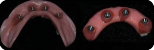 Tải lực tức thì, trước và sau khi hoàn tất phục hình