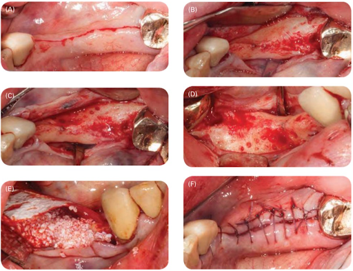 Tăng sống hàm theo chiều ngang