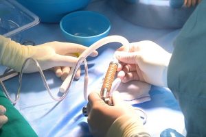 phẫu thuật ghép tim