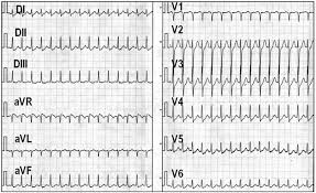 cơn nhịp nhanh kịch phát