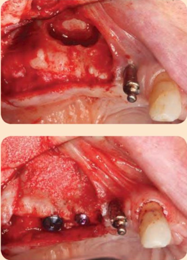 Đặt Implant với kỹ thuật cửa sổ ngoài
