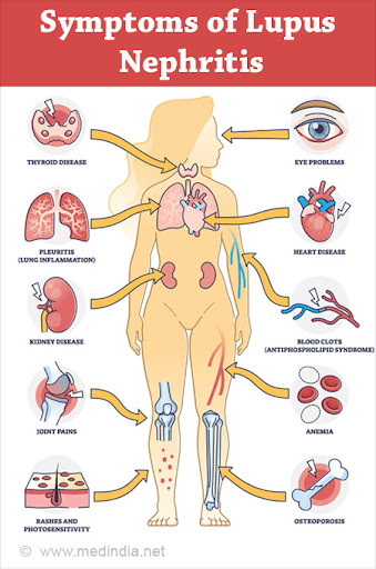 Nguồn: Lupus Nephritis