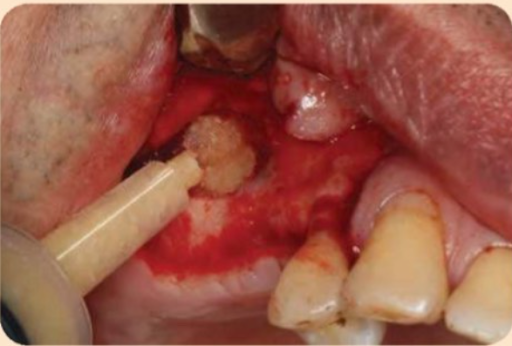 Sử dụng vật liệu ghép chứa BMPs và các yếu tố tăng trưởng