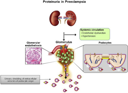 Nguồn: Proteinuria during pregnancy: definition, pathophysiology, methodology, and clinical significance