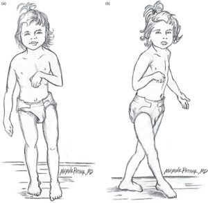 Hình ảnh minh họa bại não liệt nửa người co cứng