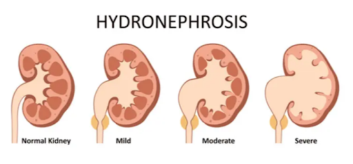 Nguồn: Hydronephrosis (Kidney Swelling)