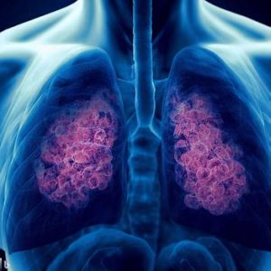 Ung thư phổi được chia thành hai loại chính dựa trên tính chất tế bào: Ung thư phổi tế bào nhỏ và ung thư phổi không tế bào nhỏ