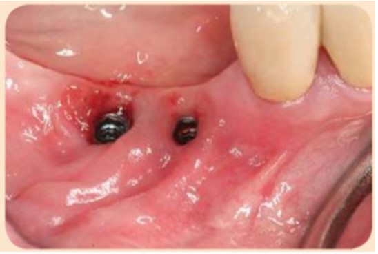 hiếu nướu sừng hóa ở mặt ngoài quanh implant càng thấy rõ hơn sau khi tháo phục hình trên implant