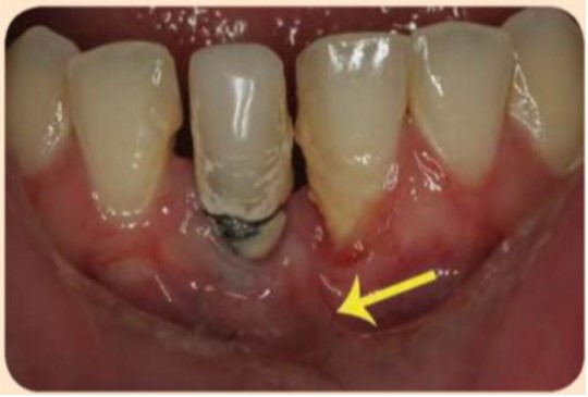 Implant #41 có chiều rộng nướu sừng hóa rất ít và bị bao phủ bởi mảng bám và vôi răng.