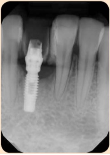 Tiêu mào xương quanh implant ở phía gần của implant #41