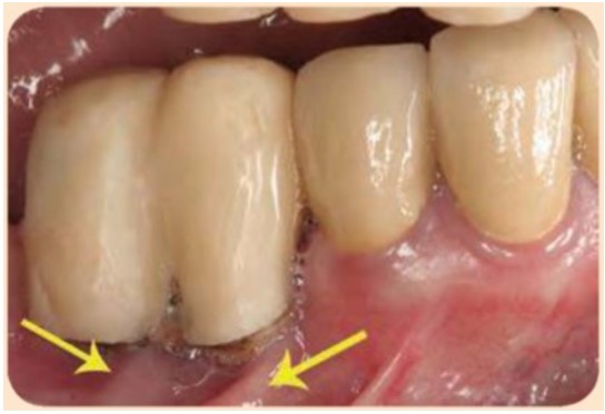 ếp gấp niêm mạc (mũi tên màu vàng) ở niêm mạc xương ở mặt ngoài