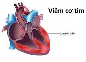 Viêm cơ tim