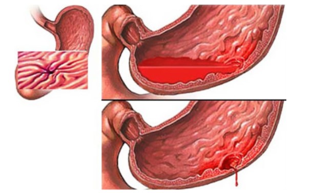 Xuất huyết tiêu hóa