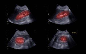 Hình ảnh sỏi thận trên siêu âm