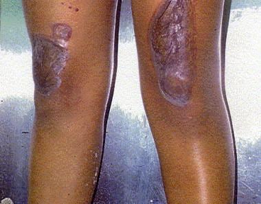 Ảnh: Tổn thương da ở bệnh nhân bị điện giật do dòng điện xoay chiều 120V. Nguồn: Medscape.