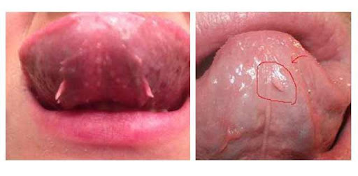 Ảnh: Cục thịt nằm dưới lưỡi. Nguồn: Vinmec.com